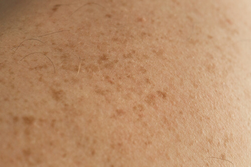 close up detail bare skin man back with scattered moles freckles checking benign moles 3 1