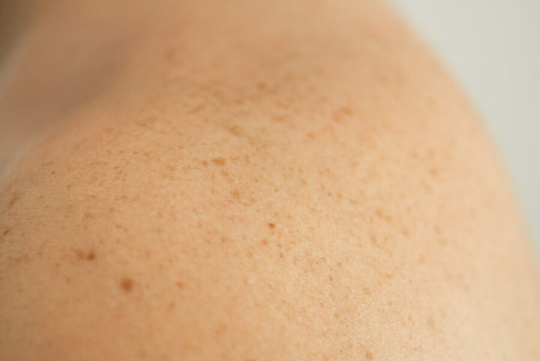 Freckles on Boobs (Should You be Worried?)