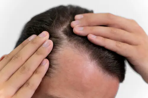 Thickening hair with onion juice