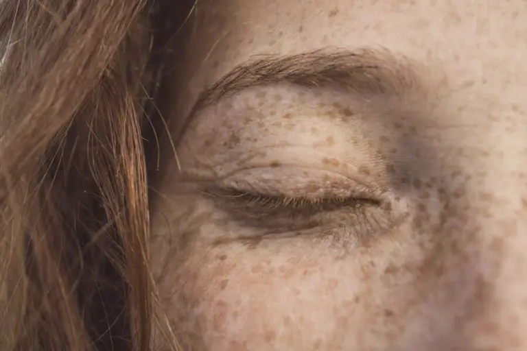 Can You Have Freckles Lighter Than Your Skin?